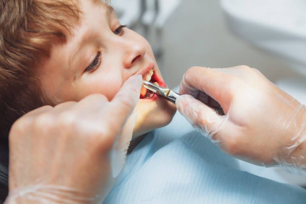 Dental Extractions