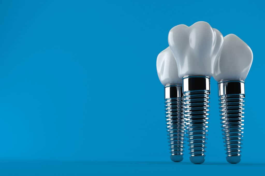 dental implants near me